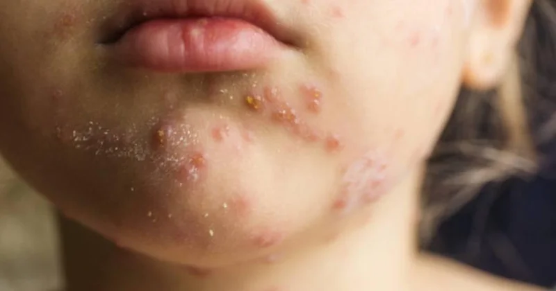 Prof. Dr. Kara dan kızamık uyarısı: Bir kişi 18 kişiye bulaştırabilir