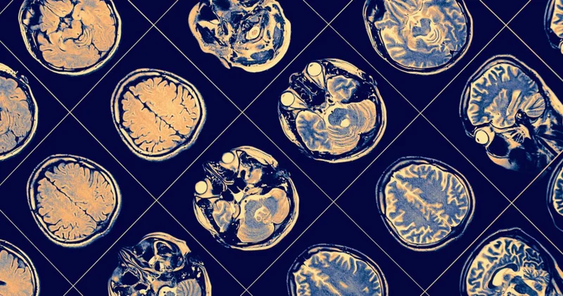 Alzheimer tanısında kan testi dönemi! Haberler