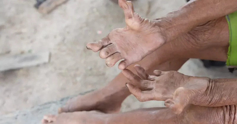 30 yıl sonra geri dönen hastalık: Romanya ve Hırvatistan’da cüzzam paniği!