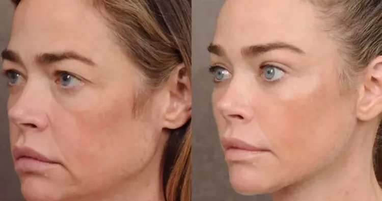 Ünlü oyuncunun kulak memeleri bile gençleşti: Hiç yalan söylemedi, yaptırdığı estetiği sergiledi: Yüzü altın gibi parlıyor