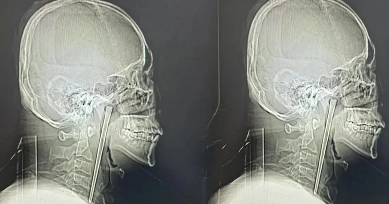 8 yıl boyunca boğazındakiyle yaşadı Sözcü Gazetesi