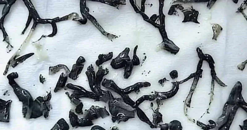 87 yaşındaki adamın akciğerinden ağaç çıkardılar Sözcü Gazetesi