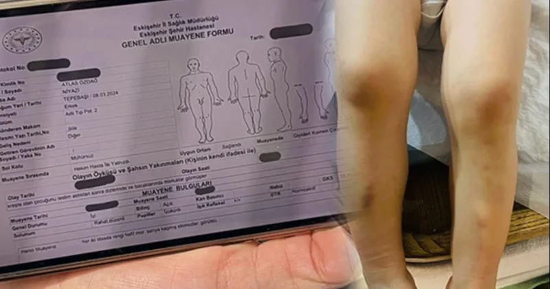2 yaşındaki Atlas ın kreş kabusu: Vücudundaki morlukları gören annesi savcılığa koştu Sözcü Gazetesi