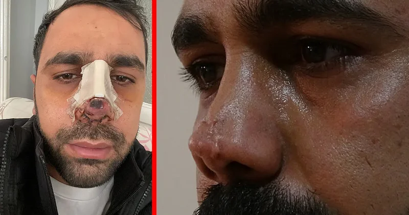 Diyarbakır’da estetik faciası! Burun ameliyatı sonrası hayatı karardı: ‘İnsanların yüzüne bakamıyorum