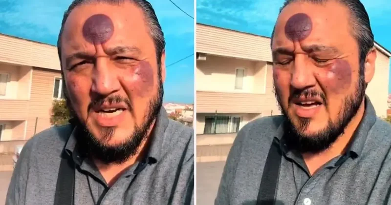 Yüzüne yaptırdığı işlemden sonra bu hale geldi, yine de savundu