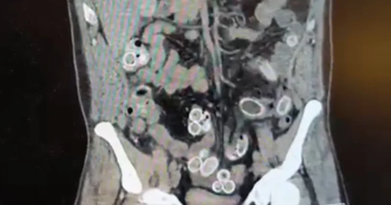 Tomografisini gören doktorlar polisi aradı, gözaltına alındı Sözcü Gazetesi