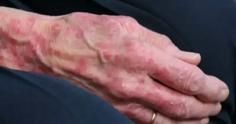 Romanya ve Hırvatistan da cüzzam vakaları görüldü: 40 yıl sonra ilk Avrupa Haberleri