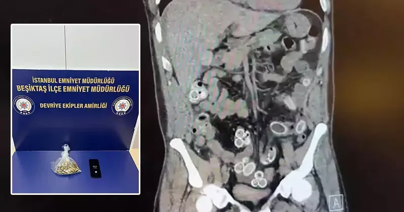 Fas’tan Beşiktaş a midesinde uyuşturucu getirdi; ameliyatla çıkarıldı