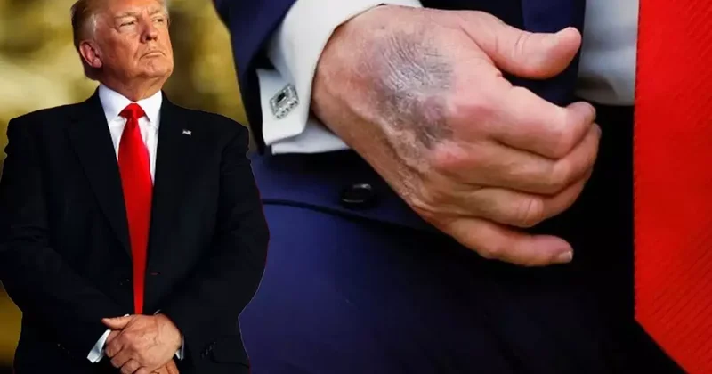 Trump ın Morarmış Eli: Masaya Çarptım, Aspirin Kullanıyorum