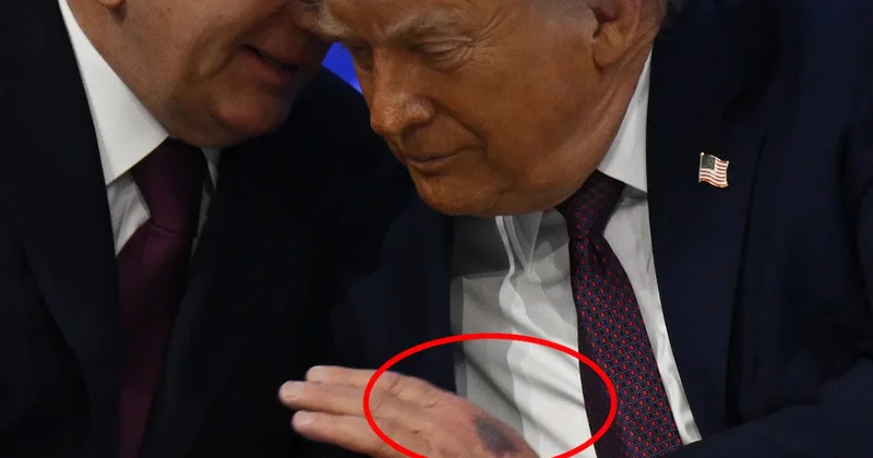 Trump ın elindeki morluğun nedeni belli oldu Sözcü Gazetesi