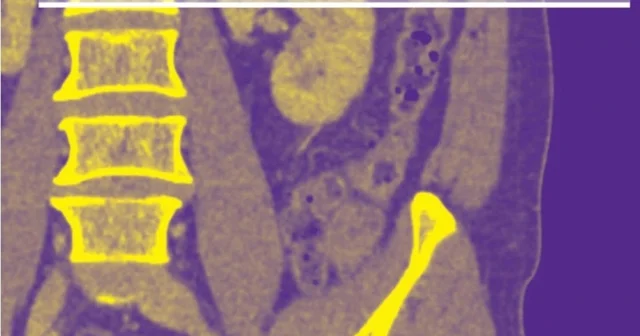 Akciğer damarındaki pıhtıların tanısında radyasyonsuz çözüm Denizli Haberleri