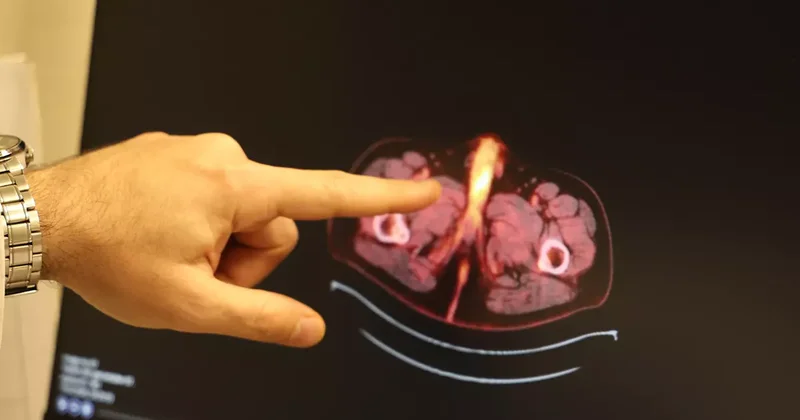 Dünyada 60 vaka var, sonuncusu Diyarbakır dan: Hastanın penisi alındı!