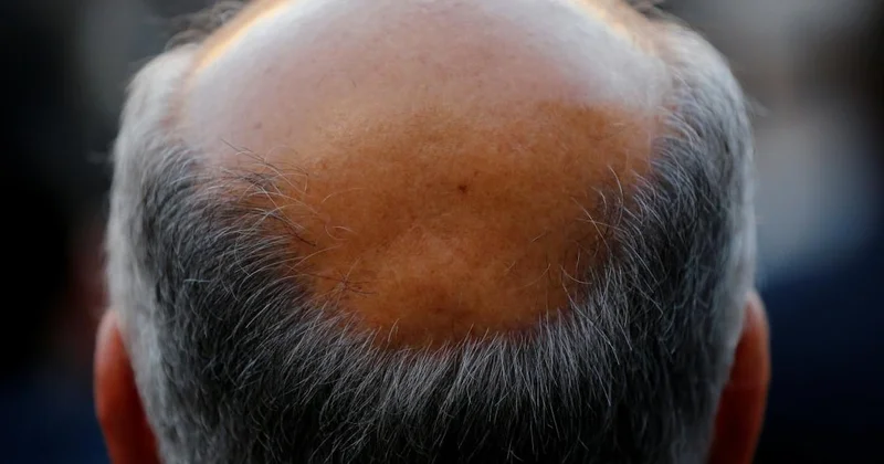 Dünyada tek bir kel bırakmayacak kimyasal ortaya çıktı Sözcü Gazetesi