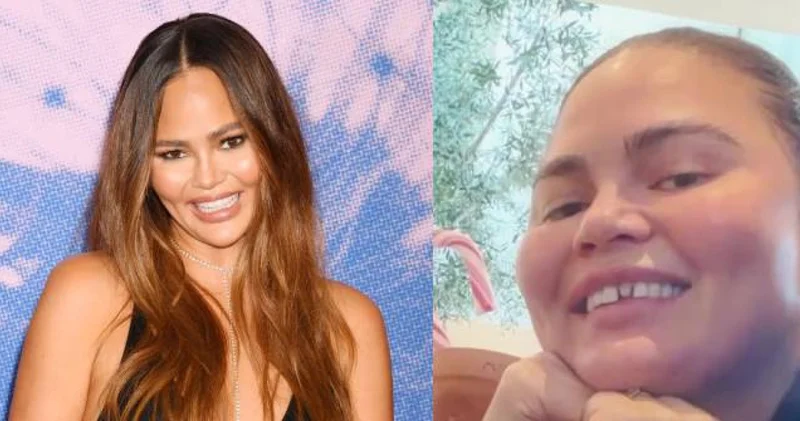 Chrissy Teigen kırıklı dişli halini göstermekten çekinmedi magazin haberleri