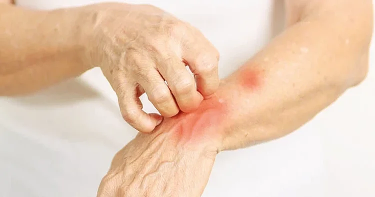 Avrupa’da cüzam paniği