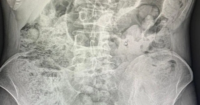 Siirt te midelerinden uyuşturucu çıkan 4 şahıs tutuklandı Siirt Haberleri