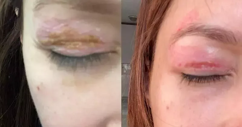 Güzellik salonundaki işlem sonrası gözünde hasar iddiasıyla yaptığı şikayet reddedildi; Uzmanına gidin uyarısı yaptı