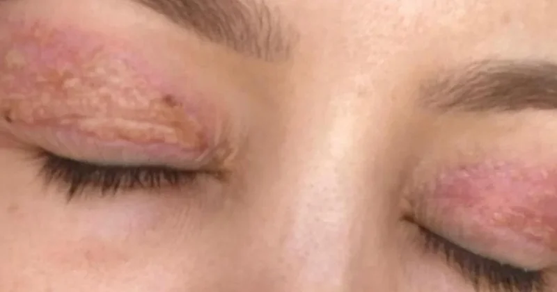 Ucuz estetik pahalıya patladı: Şimdi gözünü kapatamıyor Sözcü Gazetesi