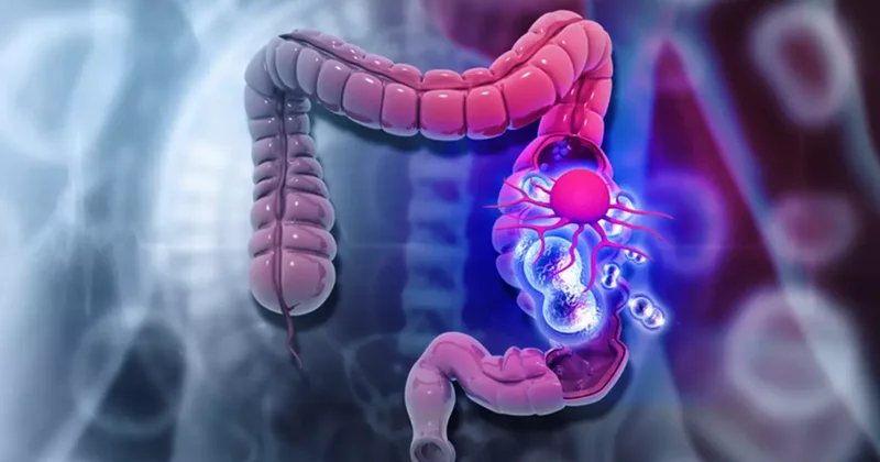 Kolon kanserinin arkasında virüs mü var? Bilim açıkladı: Kanserin içinde saklanan gizli kod