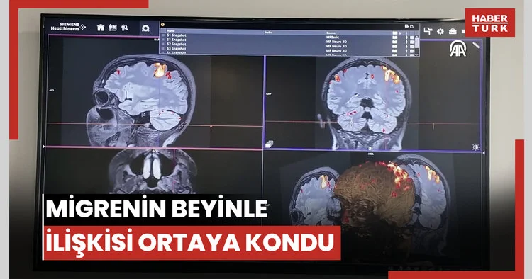 Migrenin beyindeki görsel işlemleme ve ağrı mekanizmalarıyla ilişkisi ortaya kondu