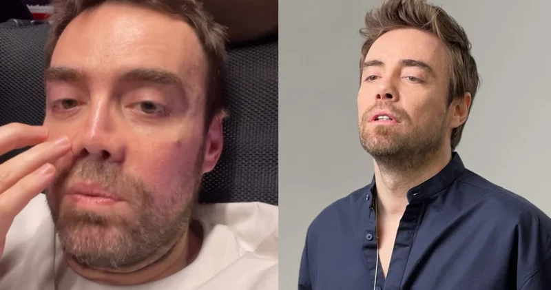 Murat Dalkılıç: İki sene sonra burnum oldu Magazin haberleri