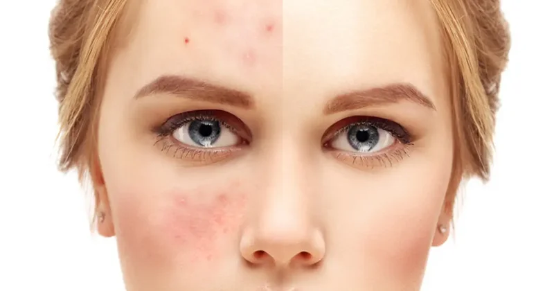 Yüzdeki kızarıklığa dikkat! Gül hastalığının belirtileri nelerdir?