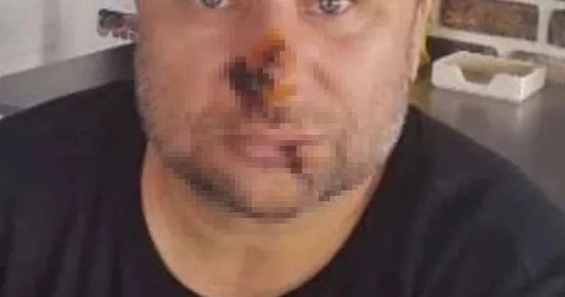 Ünlü şarkıcının yüzü çürümeye başladı! Entübe edildi