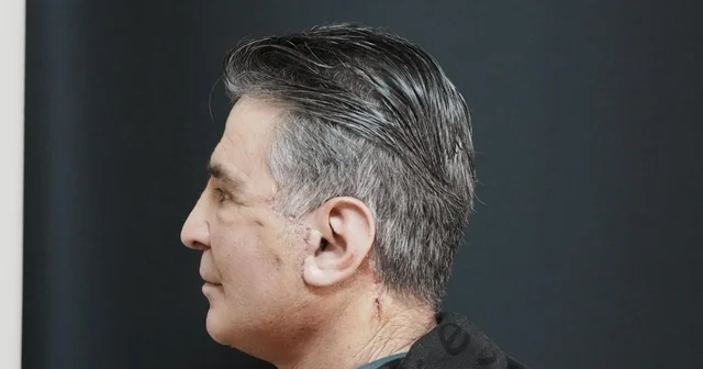 Bitlis te ilk defa yüz germe ameliyatı başarıyla yapıldı Bitlis Haberleri