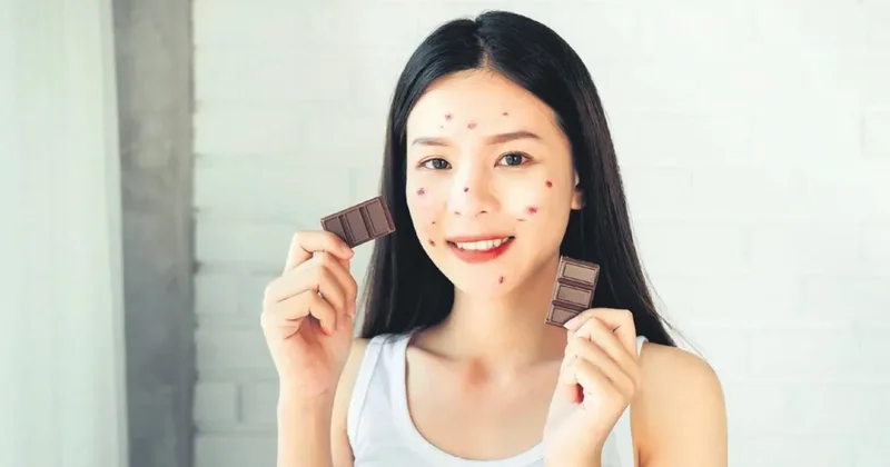 Çikolata sivilce yapar mı?