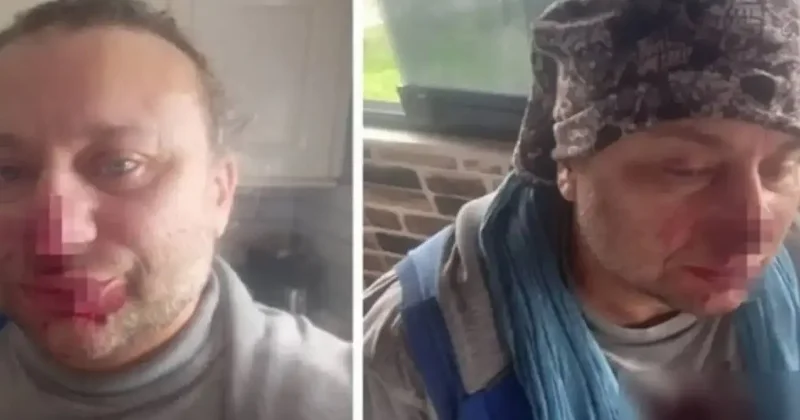 Yoğun bakımdan çıkan Onur Akay pitbull dehşetini anlattı: Ölümden döndüm