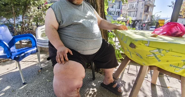Fil hastası Kazım ın tedavi olabilmesi için 82 kilo vermesi gerekiyor Edirne Haberleri Habertürk Yerel Haberler