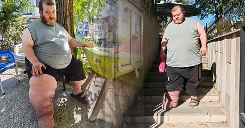 Kazım 4 yıldır bu illet hastalıkla mücadele ediyor! Doktorlar tek çare var dedi