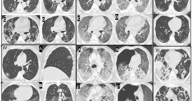 Gençlerde ani ölümler artıyor: Nedeni ise virüsün damarlarda bıraktığı hasar Samsun Haberleri