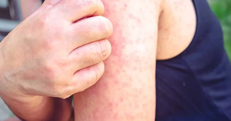 Üçüncü kızamık vakası halk sağlığı alarmına neden oldu Sözcü Gazetesi