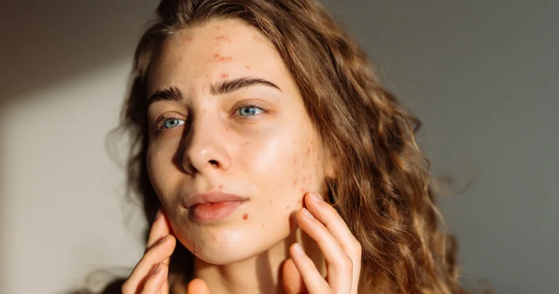 Sivilceyi kurutmak isterken artırıyor olabilirsiniz! Ani akne artışında kaçınmanız gereken 14 kritik hata