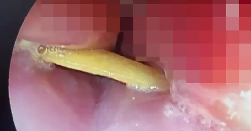 Yediği et ölümden döndürüyordu! Boğazından 5 santimlik kemik çıktı