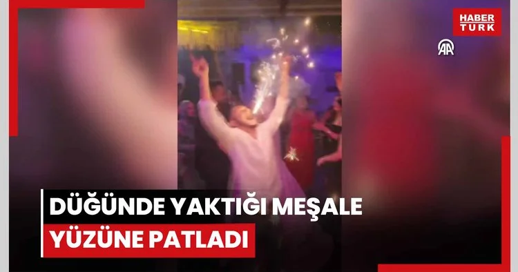 Düğünde yaktığı meşale yüzüne patladı