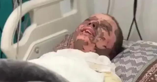 İsrail 11 yaşındaki Gazzeli Macid in vücudunda yanıklar oluşturdu VİDEO İZLE