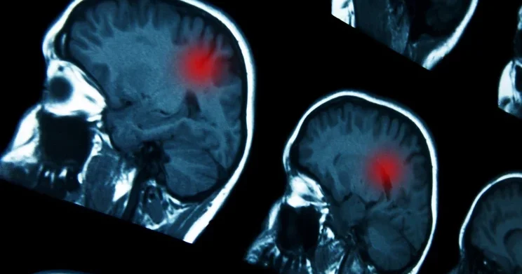 14 yaşındaki gence ‘normal’ denilen baş ağrılarının sebebi korkunç hastalık çıktı! ‘Ona bir tarama bile yapılmadı