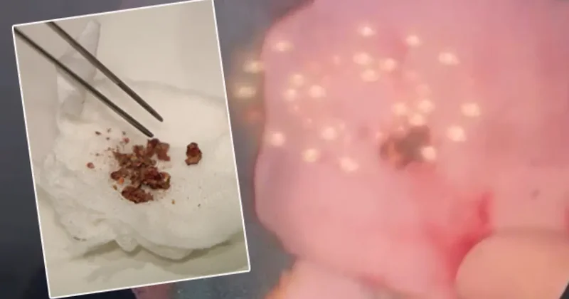 Yıllarca fark edilmedi, estetik ameliyatta ortaya çıktı: Burunda rinolit şoku!