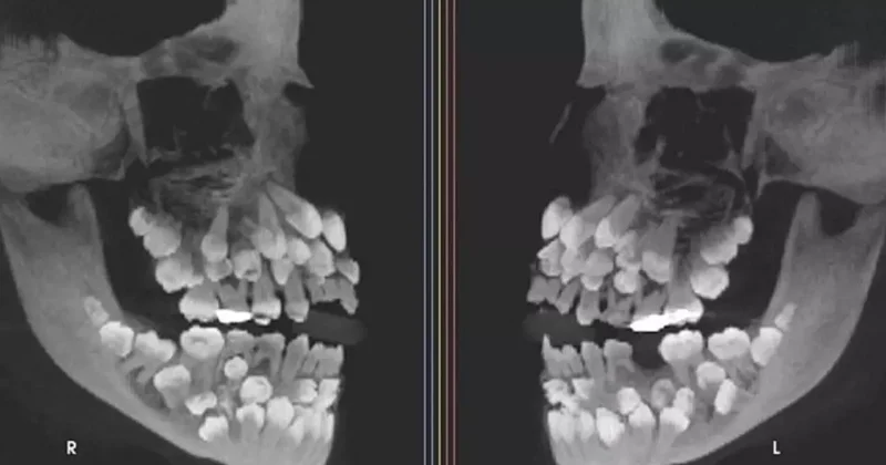 Tıp dünyası şaşkın: 11 yaşındaki çocuğun 81 dişi olduğu tespit edildi!