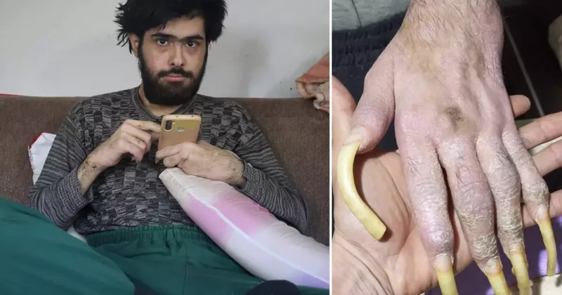 Türkiye nin konuştuğu Barış ın son hali! 25 yaşını kutladı, türkü bile söyledi