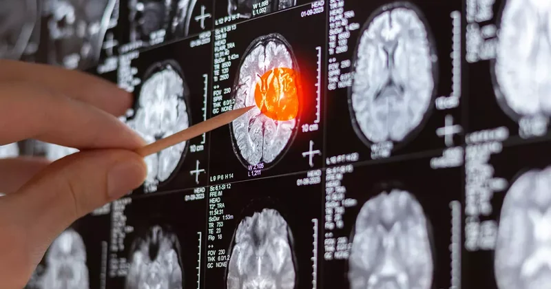 Bu belirtilere dikkat: Beyin tümörünün ilk sinyali olabilir