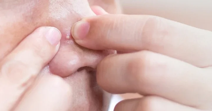 Sivilce sıkmak tehlikeli mi? Sosyal medyada görüp denemeyin