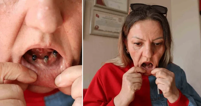 Diş ağrısı şikayetiyle hastaneye gitti, implant çetesinin eline düştü: 36 çeyrek altın harcadı, 25 dişinden birden oldu Sağlık Haberleri