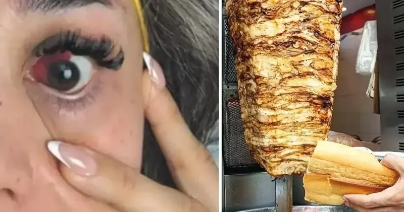 Tavuk döner yedikten sonra az kalsın gözünden oluyordu İstanbul Haberleri