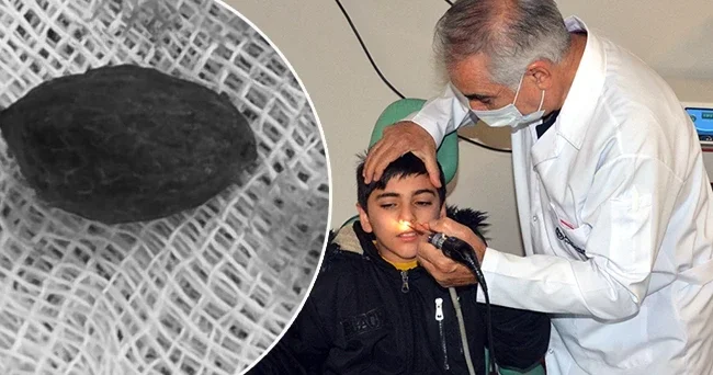 Kaşıntı şikayetiyle hastaneye gitti: Burnundan çıkanlara ailesi şaşırdı! Ameliyatta karşılaştık