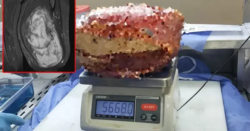 Diyarbakır’da, hastanın bacağından 5 kilo 668 gramlık kitle çıkarıldı