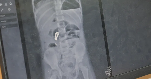 4 yaşındaki Eda nın bağırsağından 8 adet mıknatıslı boncuk çıkarıldı Mardin Haberleri