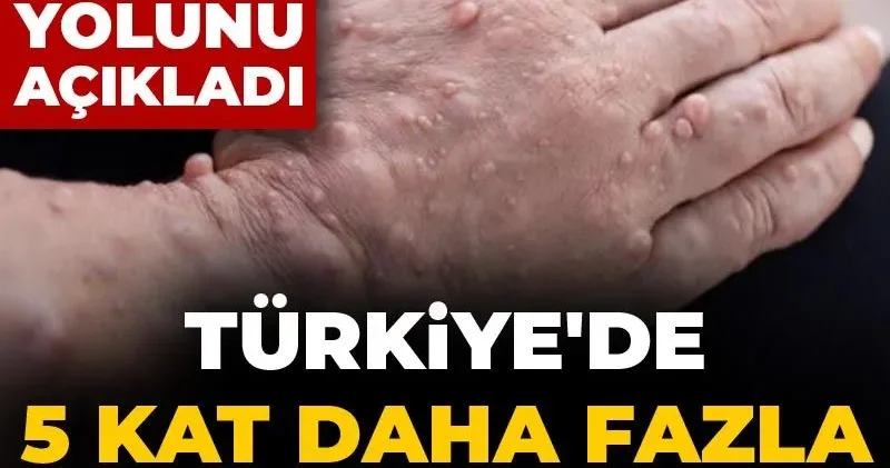 Türkiye de 5 kat daha fazla görülüyor! Nadir hastalığı engellemenin yolunu açıkladı